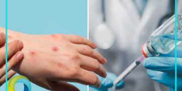 Suma Q. Roo cinco casos de sarampión