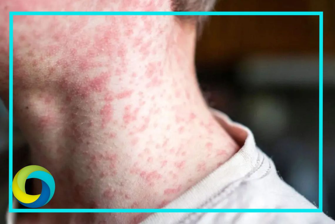 OPS emite alerta epidemiológica por el sarampión; México a la cabeza la lista